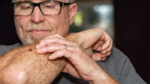 Skin Cancer Alert: How to Recognize Early Warning Signs on Your Skin