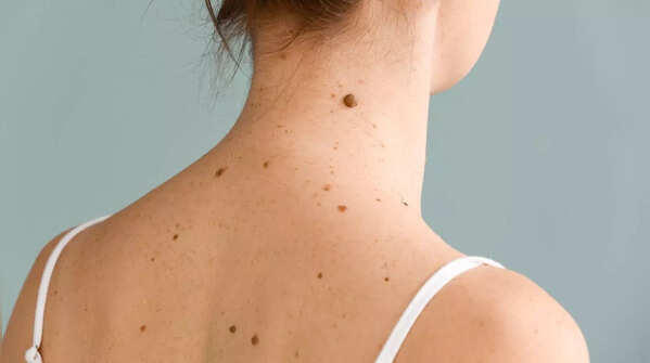 Detecting new skin growths, lumps, or bumps