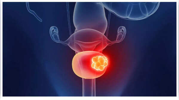 Woman experiencing lower back pain, a potential sign of bladder cancer.