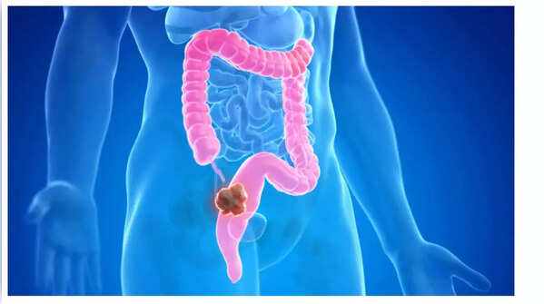Weight loss and colon cancer risks