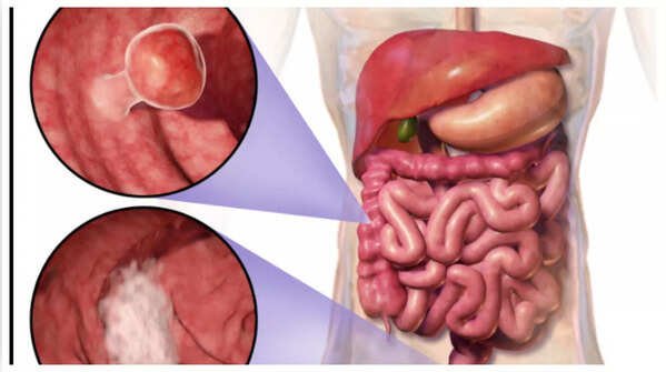 Detecting blood in stool, a key indicator