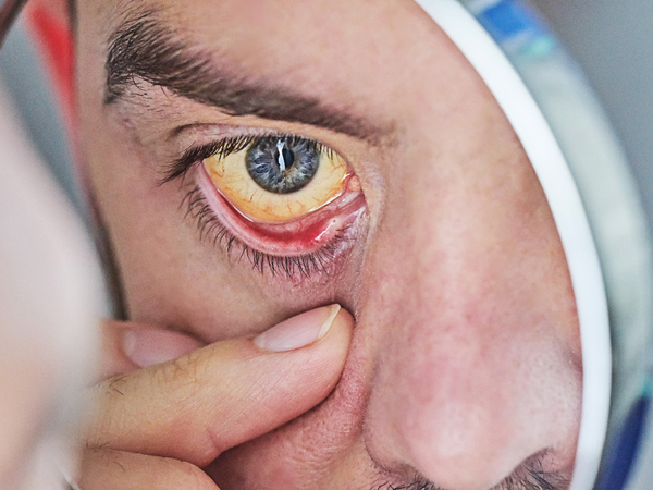 Yellow eyes are a telling sign of jaundice.